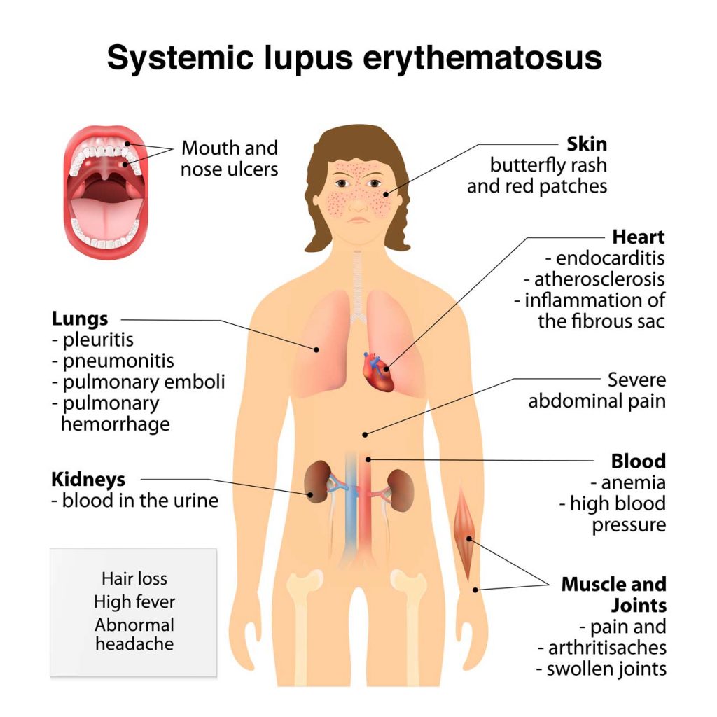 penyakit lupus