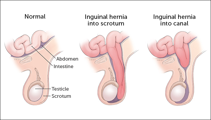 hernia bayi